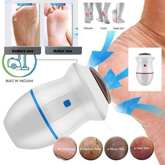 Electric Back Callus Remover with Built-In Vacuum – Rechargeable Foot Grinder for Dead Skin, Cracked Heels & Calluses